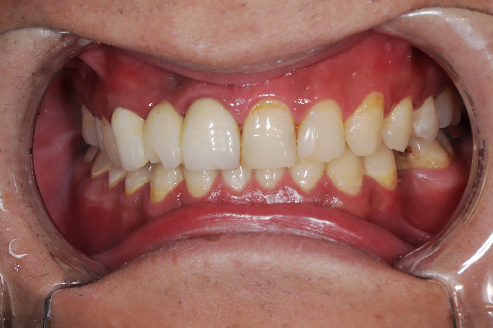 前歯部インプラントの術前