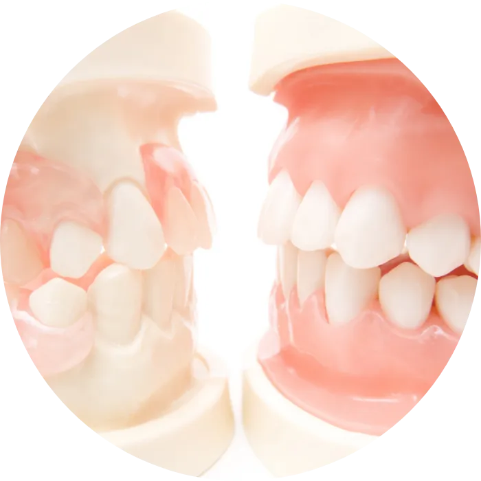 かみ合わせ治療