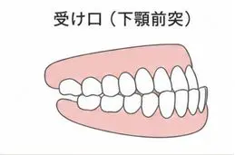 受け口