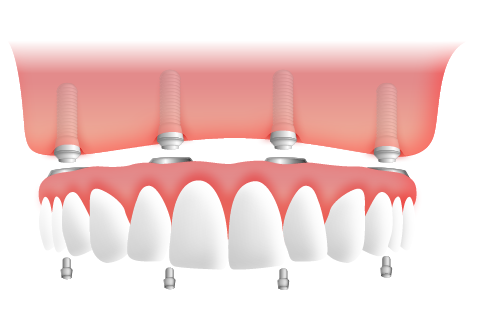 オールオン4治療とは？|東京・新宿でオールオン4/6ならプラム四谷歯科クリニック