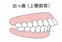 出っ歯