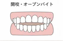 開咬
