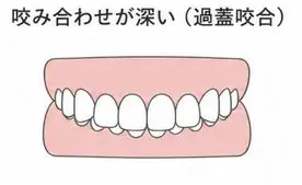 過蓋咬合