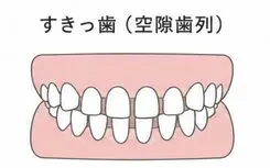 すきっ歯