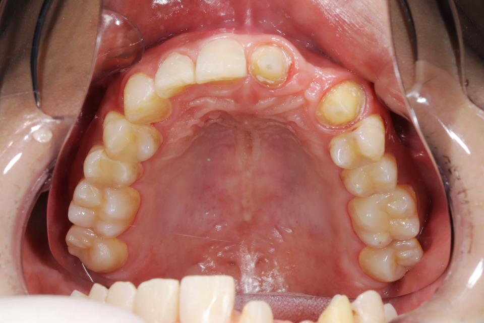 前歯部インプラント治療の術中2