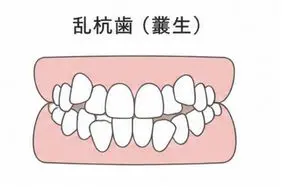 乱杭歯