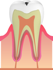 虫歯のごく初期の段階を定期検診で見つけることができれば、歯を削らずに済みます