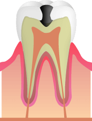 虫歯の初期状態を放置していると、歯の表面のエナメル質がさらに溶けて黒ずみ始めます
