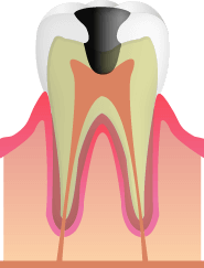 さらに虫歯が象牙質まで進んでしまうと、滲みたり、痛みが出てきたりしてきます