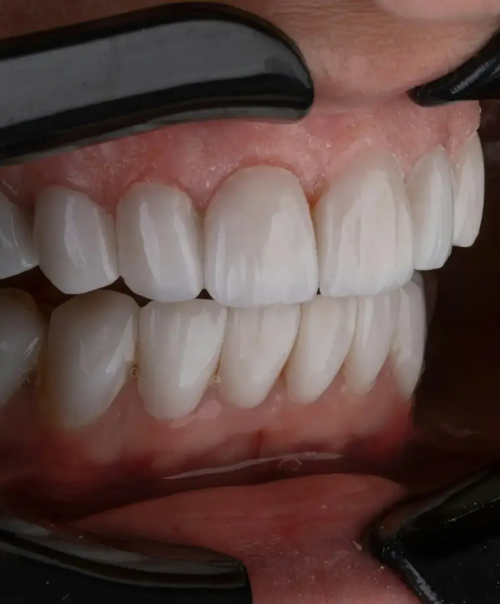 ダイレクトボンディング